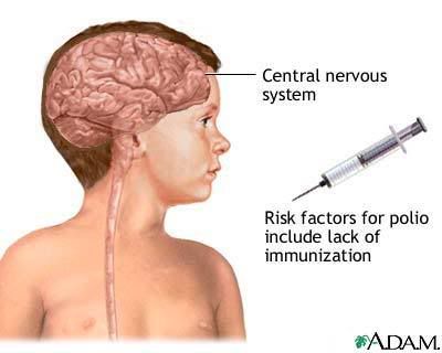 polio Poliomyelitis