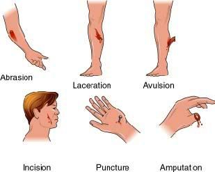 incised wound